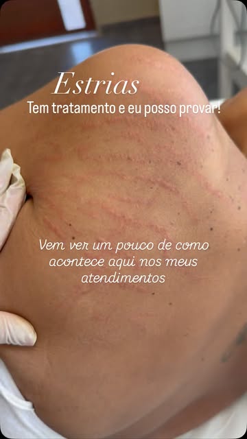 Registro de tratamento de estrias publicado no Instagram